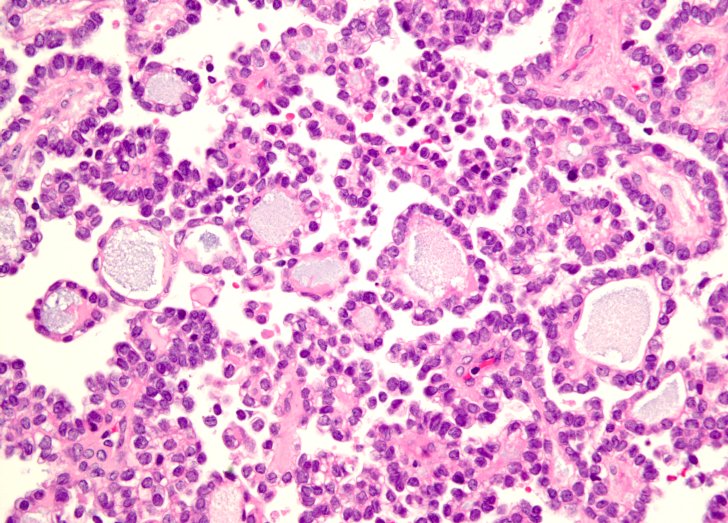 adenoid cystic carcinoma